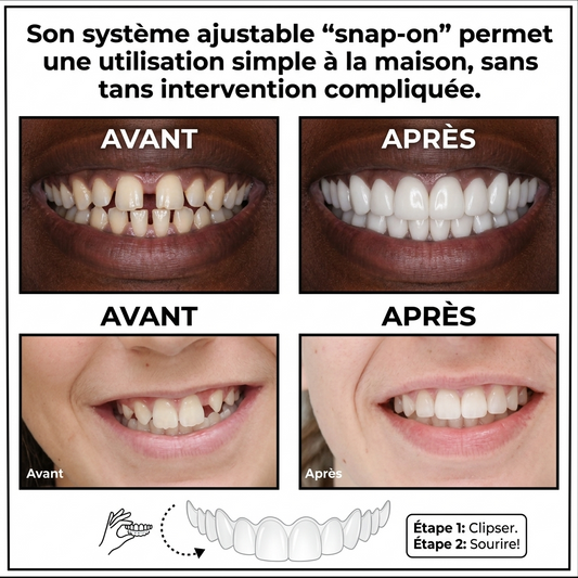 Prothèse Anti-Dents Cassées
